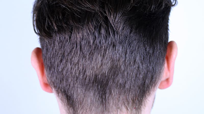 Hair implant after healing