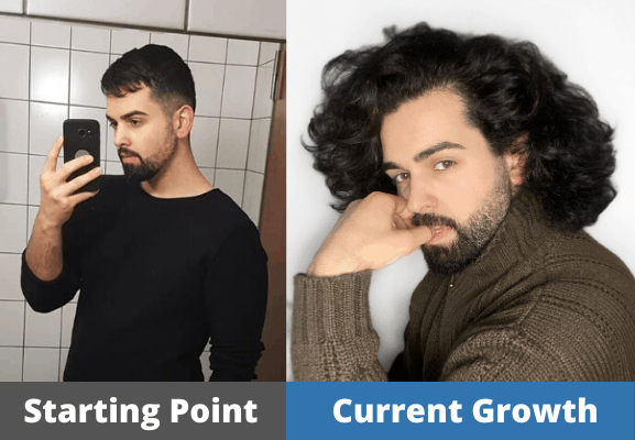 Enver's Hair growth Journey