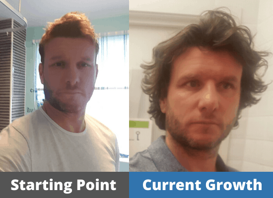 Luke's Hair growth Journey