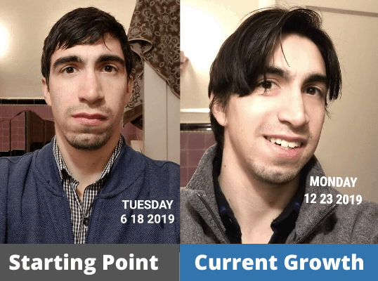 Robert's Hair growth Journey